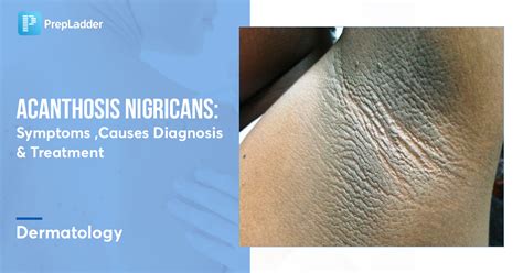 Acanthosis Nigricans Symptoms Causes Diagnosis And Treatment