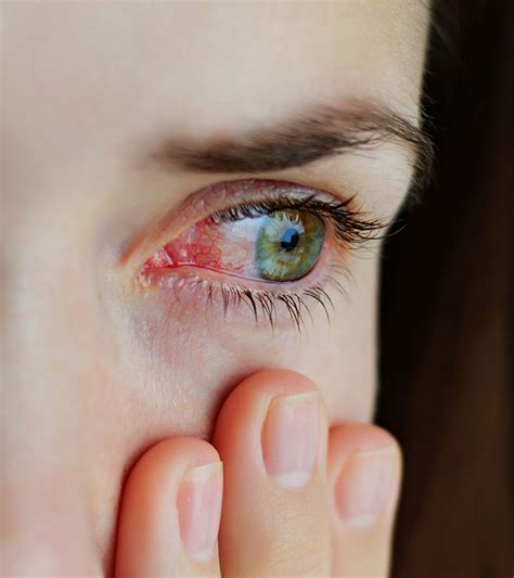 Pink Eye Conjunctivitis Types Causes Symptoms And Natural