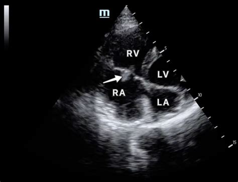 Trick Of The Trade Making Your Own Homemade Ultrasound Gel