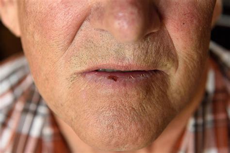 Actinic Keratosis On Lower Lip Photograph By Kevin Link Hot Sex