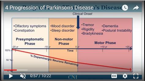 Parkinsons Disease Stages Timeline