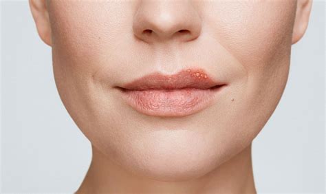 Cold Sore On Face Pictures Photos