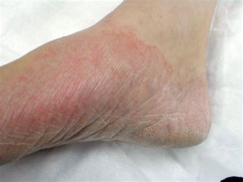 Fungal Infection On Leg Candida Skin Fungus Medical Pictures Info