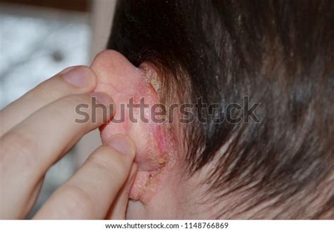 Psoriasis Behind Ear Psoriasis On Nails Stock Photo 1148766869