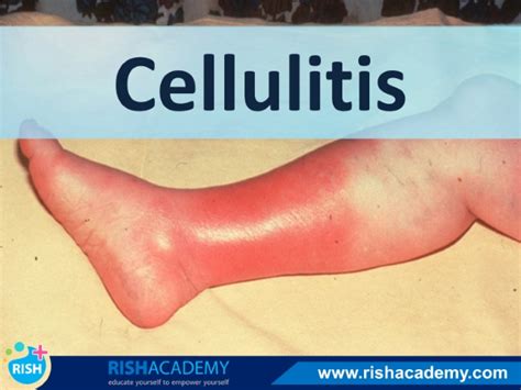Cellulitis Rish Academy Common Bacterial Infection