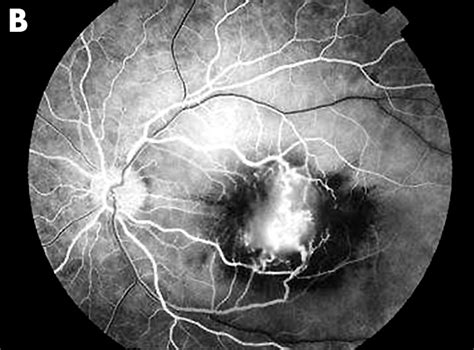 Unusual Presentation Of Cat Scratch Disease In Hiv Patient British