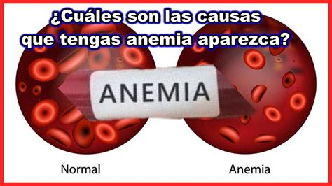 Necesita Saber Esto Todo Lo Que Necesitas Saber Sobre La Anemia