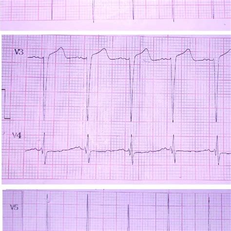 Patients Ecg Showing Precordial Leads Only With St Elevation In V2