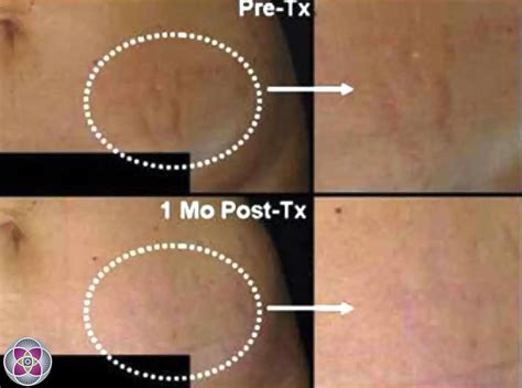 Laser Treatment To Remove Stretch Marks
