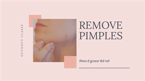 how to remove pimple overnight पिम्पल से छुटकारा कैसे पाये youtube