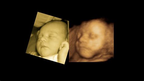 3d 4d Baby Scan With Side By Side Scan And Baby Photos Even A Smile