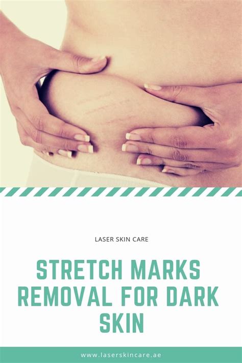 Best Stretch Marks Removal For Dark Skin Laser Skin Care Clinic