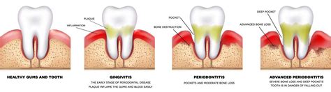 Types Of Gum Disease Sky Periodontics Drs Yasner Kazemi And La