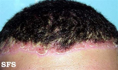 Scalp Psoriasis And Similar Head Rashes Pictures Treatment