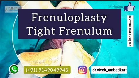 Frenuloplasty Tight Frenulum Short Frenulum Circumcision Phimosis Youtube