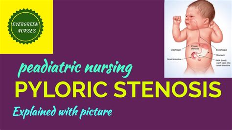 Pyloric Stenosis In Babies Youtube