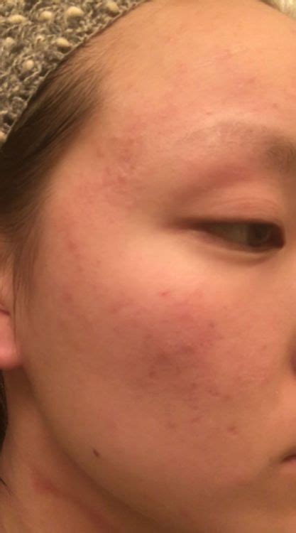 Red Itchy Bumpy Rash On Face General Acne Discussion