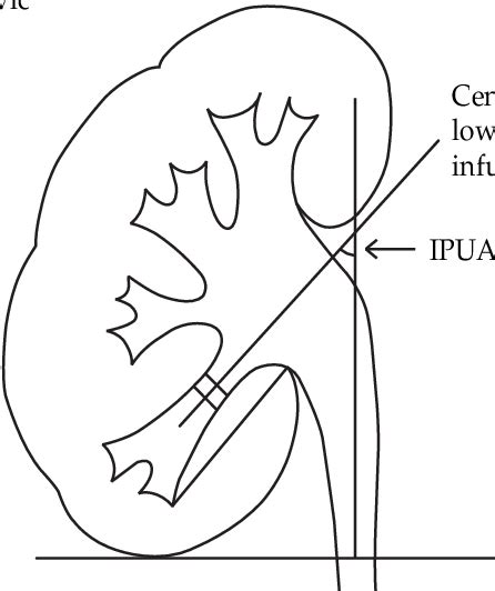 Lower Pole Calyx Kidney Stones - Kidney Failure Disease