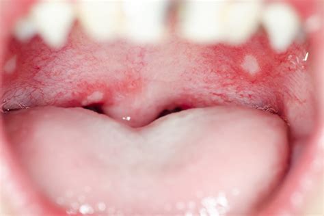 Causes Of Canker Sores In Children Its Symptoms And Treatment