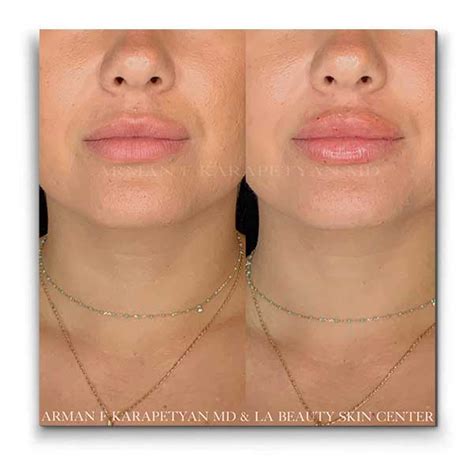 Temporary Lip Fillers Get Fuller Lips La Beauty Skin Center