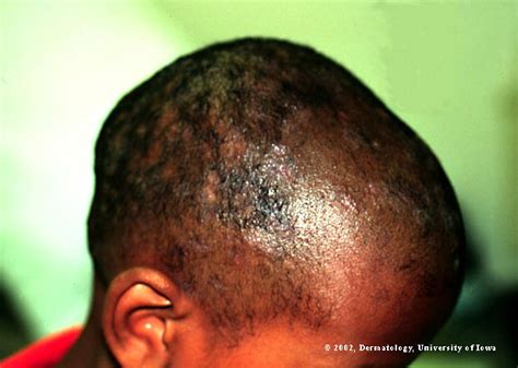 Ringworm Picture From Ui Dermatology Tinea Capitis 1 Hardin Md