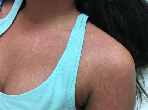 When a person starts with an amoxicillin rash it will usually start on your stomach and then cover your back. Infectious Mononucleosis: Pharyngitis and Morbilliform ...