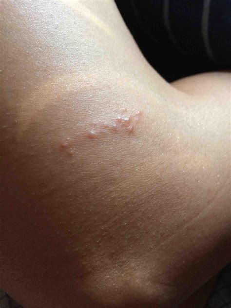 Eczema That Looks Like Blisters