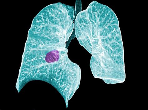 Doctors Arent All That Good At Helping Patients Decide On Lung Cancer