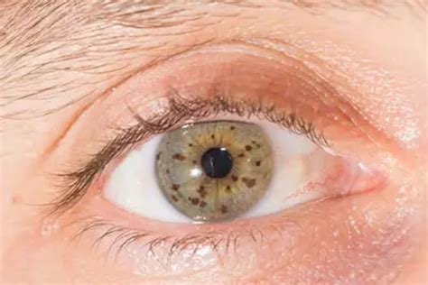 What Is Nevus Eye Freckle Eye Conditions The Eye News