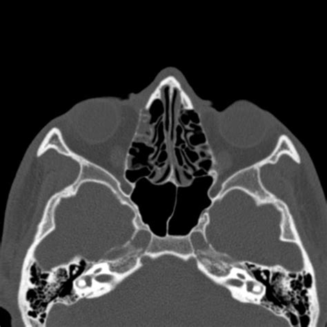 Depressed Fracture Of The Anterior Wall Of The Right Maxillary Sinus