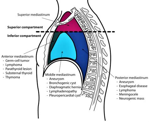 Mediastinal Lymph Nodes Mediastinal Lymphadenopathy Causes