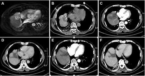 Computed Tomography Guided Percutaneous Cryoablation For ‎ Subcard Cmar