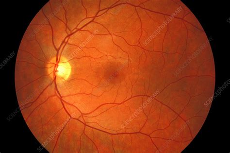 Healthy Eye Fundus Image Stock Image C0261050 Science Photo Library
