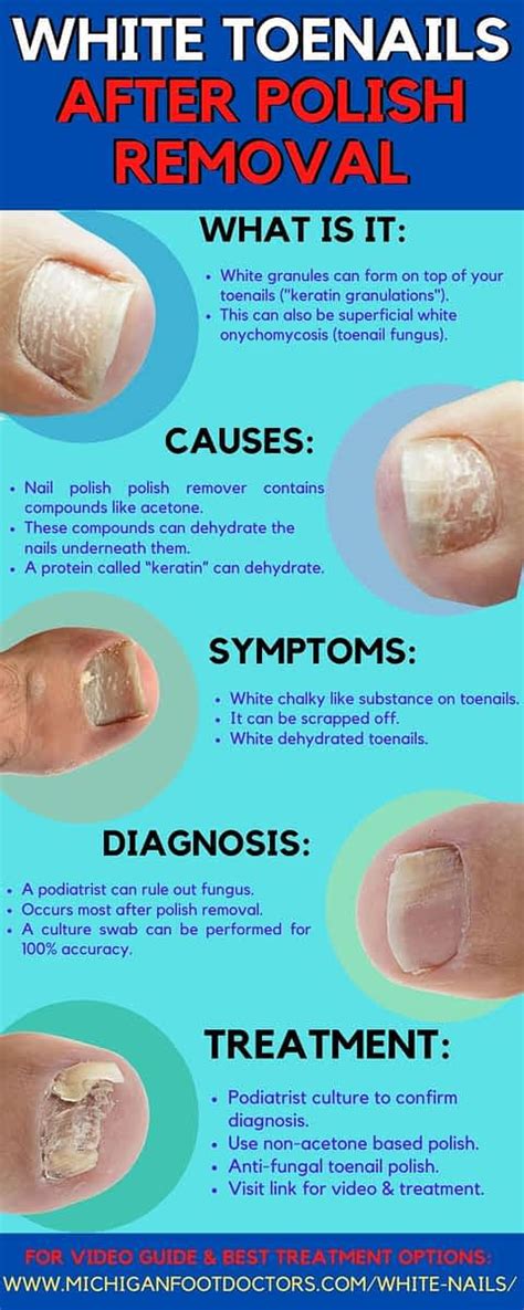 Keratin Granulations Or Toe Nail Fungus Causes And Best Treatment