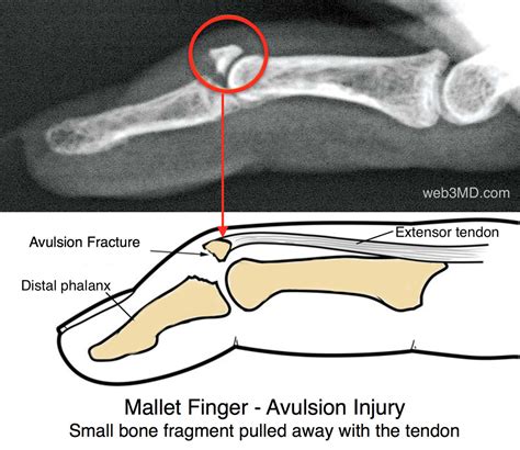 Avulsion Fracture Finger
