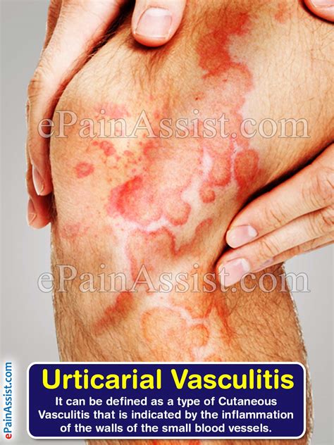 Urticarial Vasculitis Types Causes Symptoms Treatment Prognosis