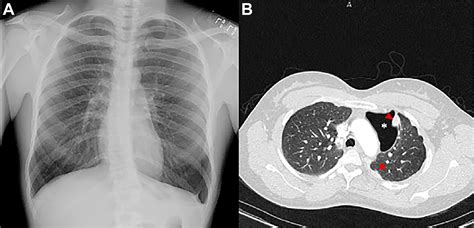 Mediastinal Synovial Sarcoma 14 Years After Talc Pleurodesis For