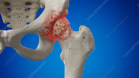 Arthritic Hip Joint Illustration Stock Image F0352815 Science