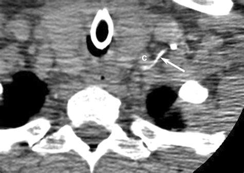 Normal Ct Appearance Of The Distal Thoracic Duct Ajr