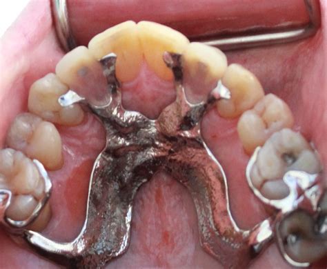 Partial Dentures Plates