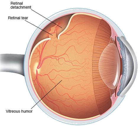 Retinal Detachment - Causes, Signs, Symptoms, Surgery, Repair