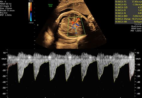 Middle Cerebral Artery MCA Doppler Waveforms Obtained From The