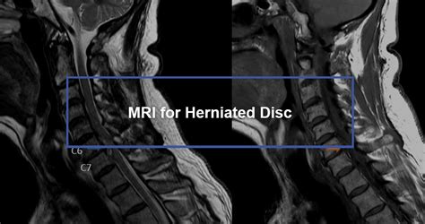 Mri For Herniated Disc Dr Kevin Pauza