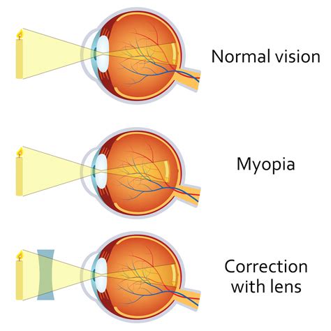 Nearsightedness San Jose Eye Doctor Santa Clara Spectrum Eye