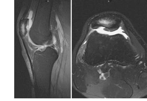 Grade 4 Subchondral Bone Marrow Edema In A Patient With Isolated And Download Scientific