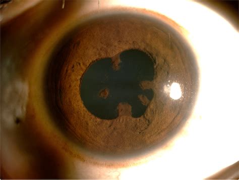 Slit Lamp Photograph Of Right Eye Spill Over Anterior Uveitis With