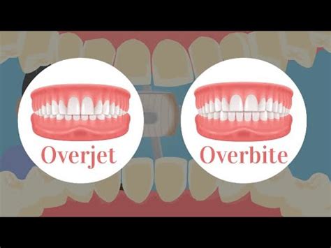 Overjet Vs Overbite Teeth Orthodontics Facts Learn YouTube