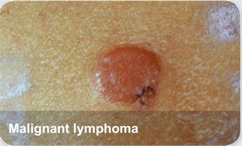 Oncology Diseases Malignant Lymphoma Elabscience