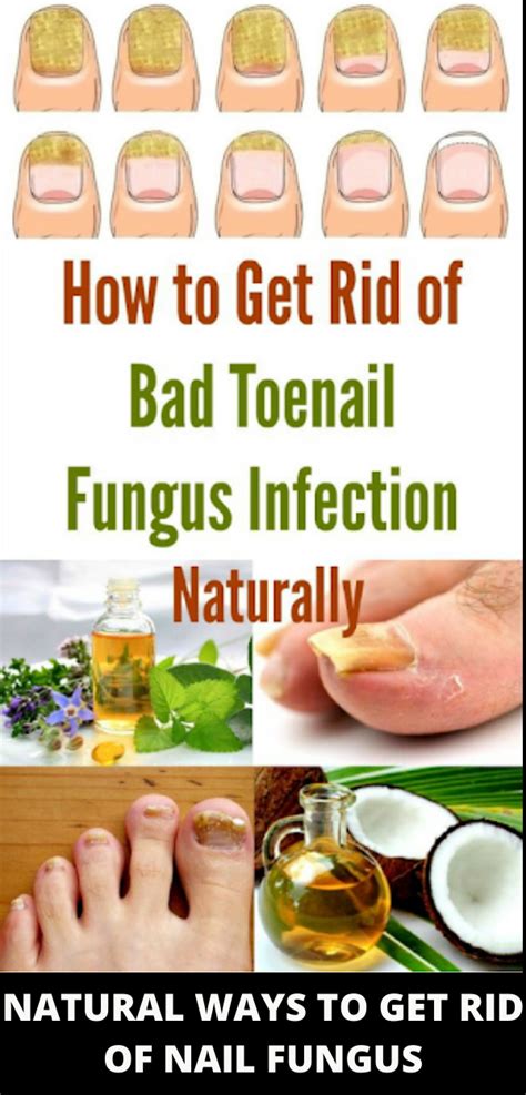 How To Get Rid Of Toenail Fungus Using Just 3 Simple Home Remedies Healhty And Tips