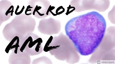 Acute Myeloid Leukemia Auer Rod In A Blast On Peripheral Blood Smear